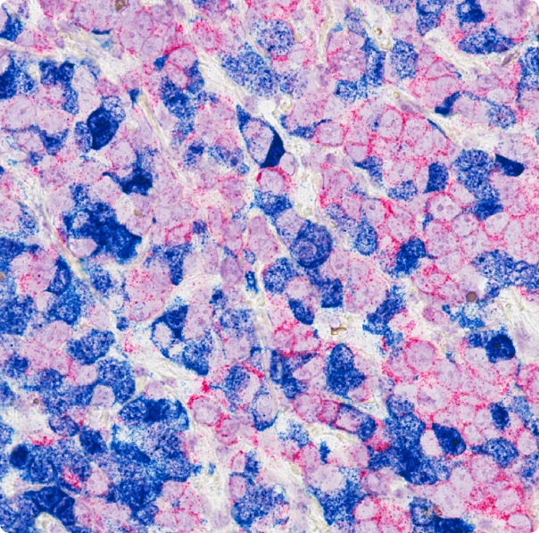 Šta je metastatski karcinom dojke?